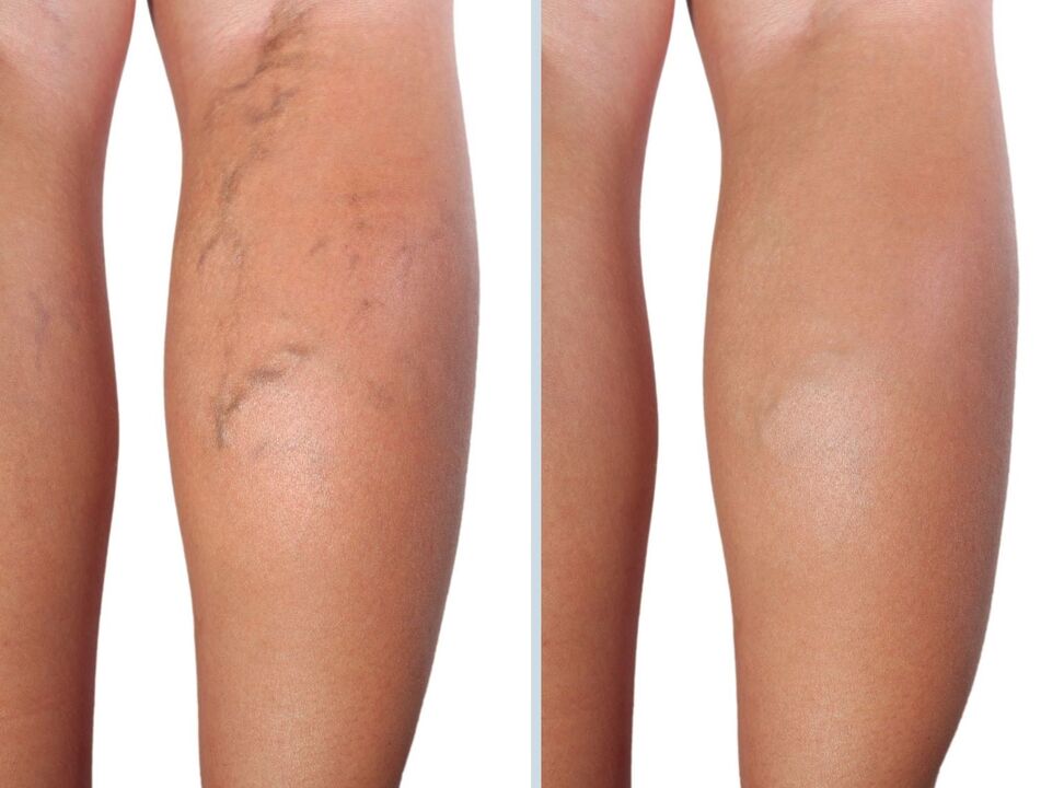My experience in applying Neuveris gel