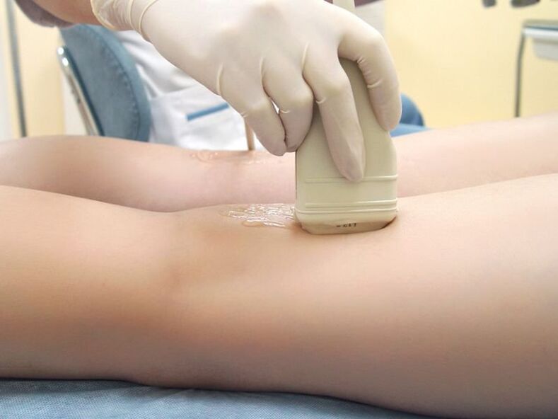 Treatment of varicose veins