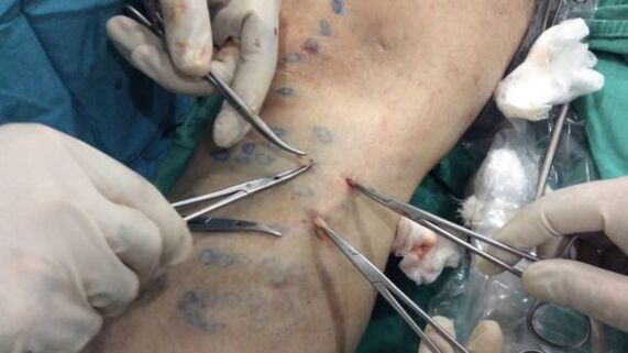 operation