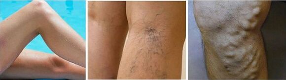 The appearance of varicose veins on the legs
