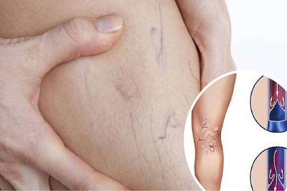 varicose veins photo