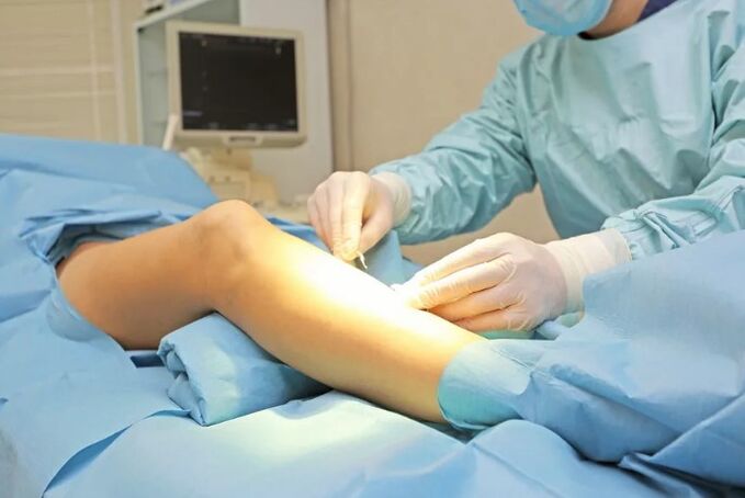 Operation for the removal of veins on the legs
