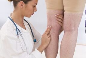 Phlebologist examines a patient with varicose veins