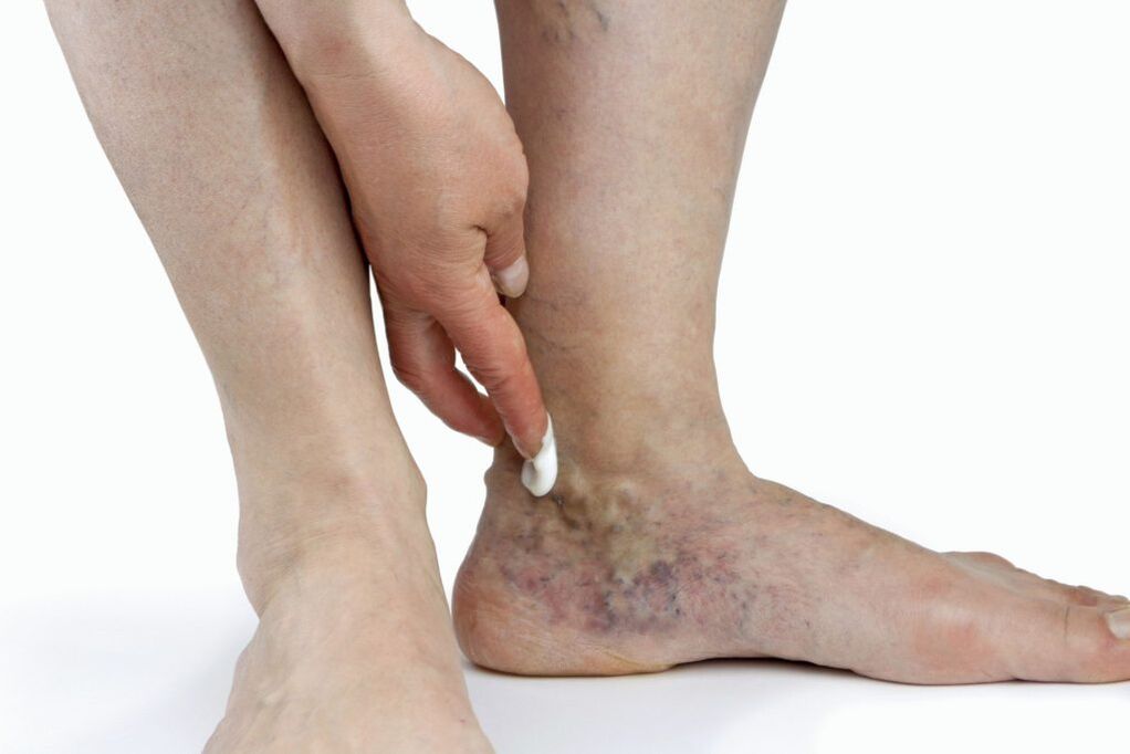 Varicose veins of the lower extremities